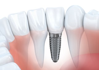 dental implants gurnee
