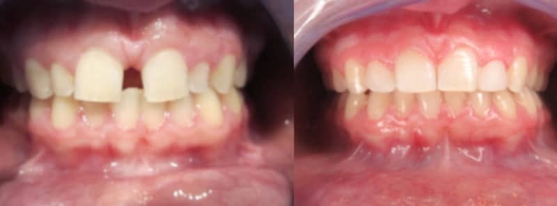 Before and after Invisalign photo