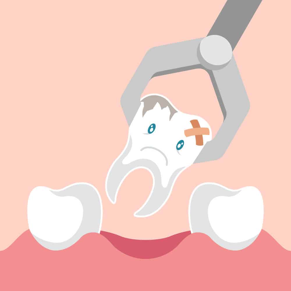 tooth-extraction-6701085.jpg