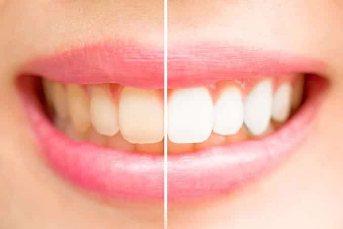 glenwood teeth-whitening