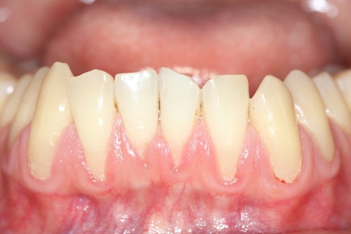 5 Reasons Why You Have Receding Gums | Carolina Dental Arts