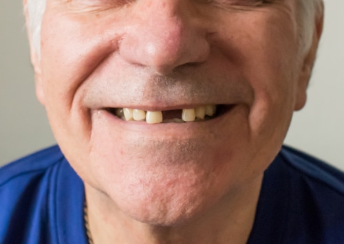 What Happens If I Don’t Replace A Missing Tooth?