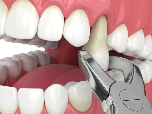 When Do You Need an Emergency Tooth Extraction