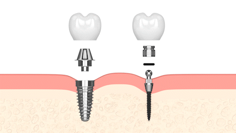 Alternativas ClearChoice en Carolina del Norte | Mini Implantes Dentales
