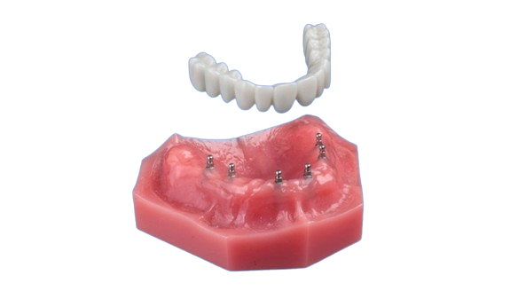 Fix-on-Six in North Carolina | A Secure Alternative to Dentures