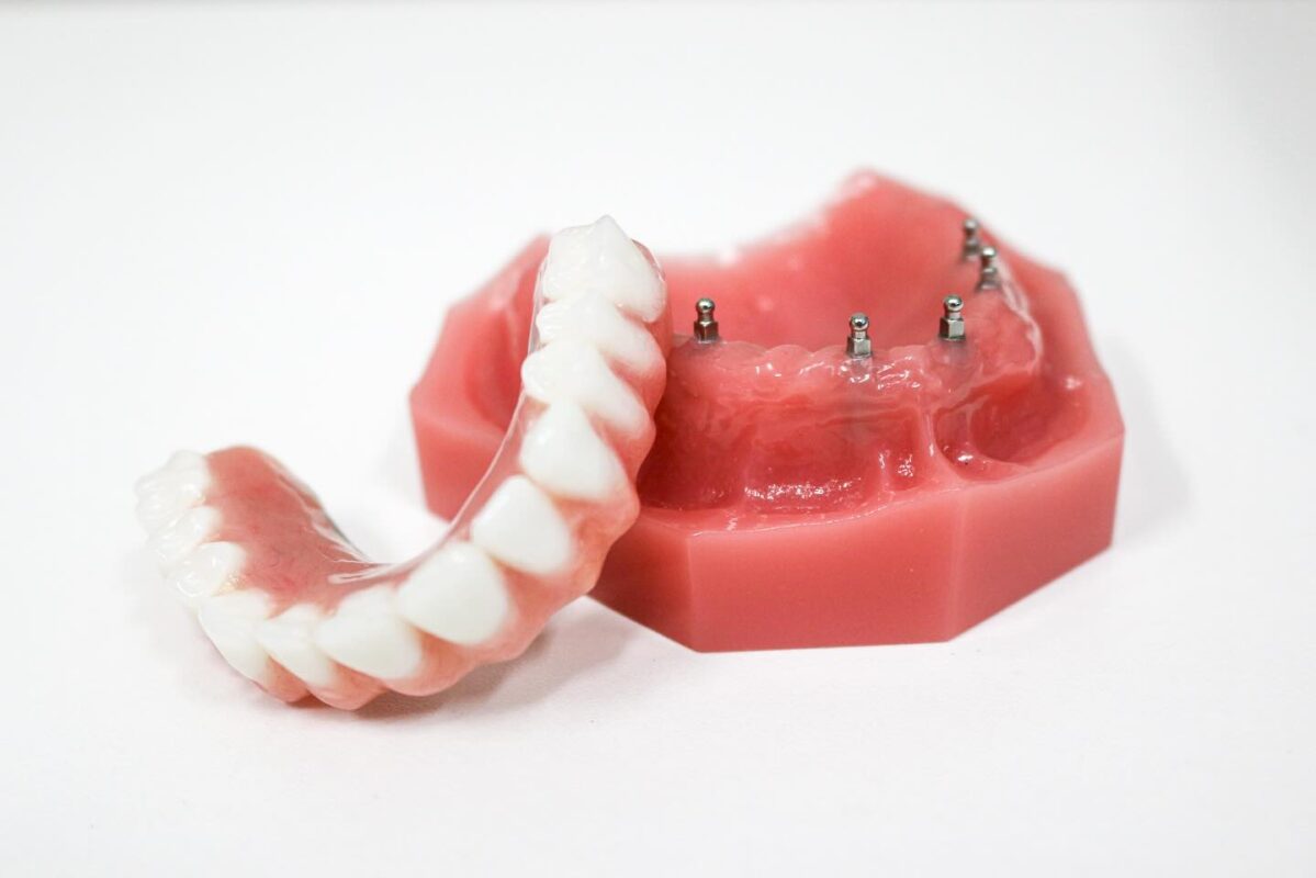 Mini Implant Dentures in North Carolina | Book a Free Consultation