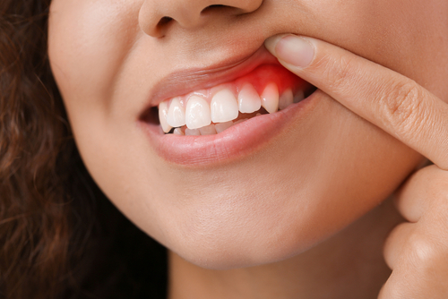 Inflamed Gums | Gum Disease Treatment in North Carolina1