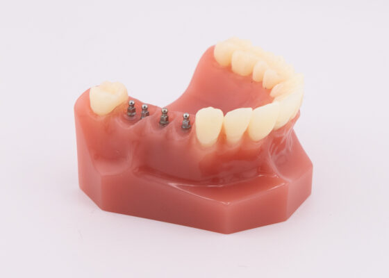 Implant Bridge in North Carolina | Affordable Tooth Replacement