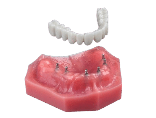 What Is a Roundhouse Dental Bridge | Implant Dentures in North Carolina