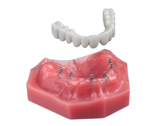 What Is a Roundhouse Dental Bridge | Implant Dentures in North Carolina
