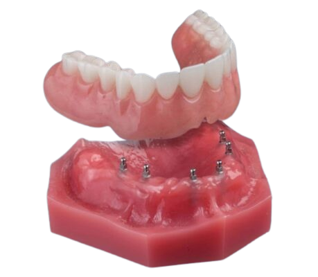 Mini Implants for Dentures in North Carolina | Free Consultations