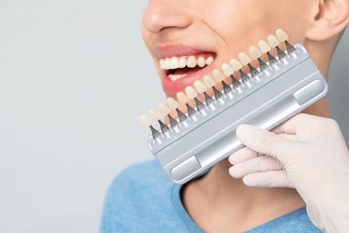 Dental Veneer Cost in North Carolina | Payment Plans Available