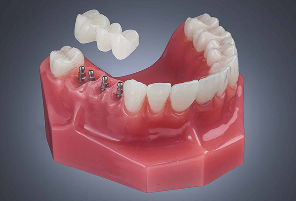 Puentes sobre implantes en Carolina del Norte | Consultas gratuitas