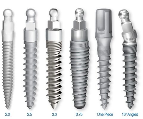 Types of Dental Implants in North Carolina | Free Consultations
