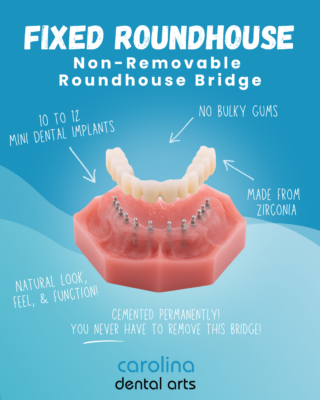 Full Mouth Implants in North Carolina | Fixed Roundhouse