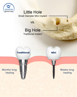 Implant Center in Durham, NC | One-Piece Implant vs. Traditional Implant