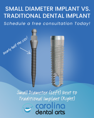 Implantes dentales de diámetro reducido en Carolina del Norte | Miniimplantes frente a implantes tradicionales