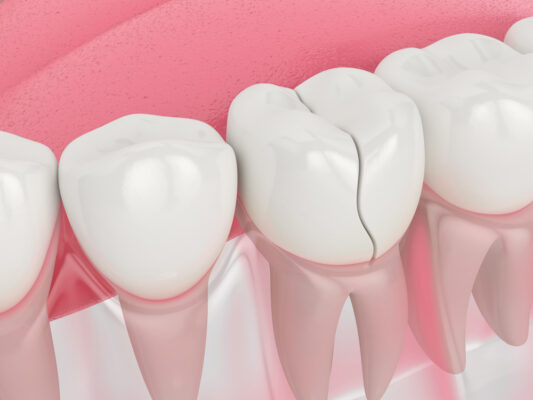 Dentista de urgencias en Durham, Carolina del Norte | Atención dental urgente cerca de mí