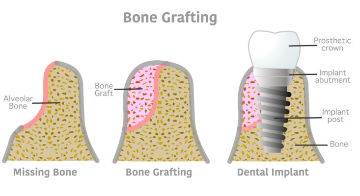 Bone Graft for Dental Implant | Free Consults in North Carolina